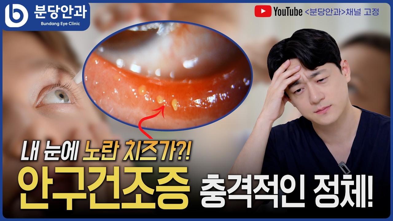 안구건조증 충격 정체! 내 눈에서 노란 치즈가?
