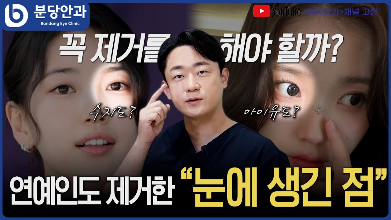 수지도 제거한 눈 점 결막모반 제거 부작용?
